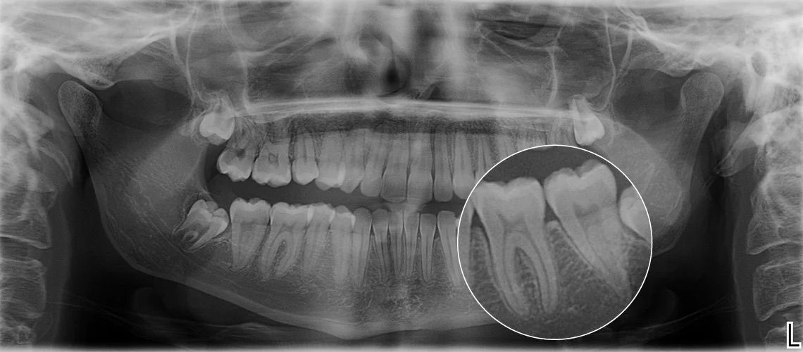 panoramic x-ray
