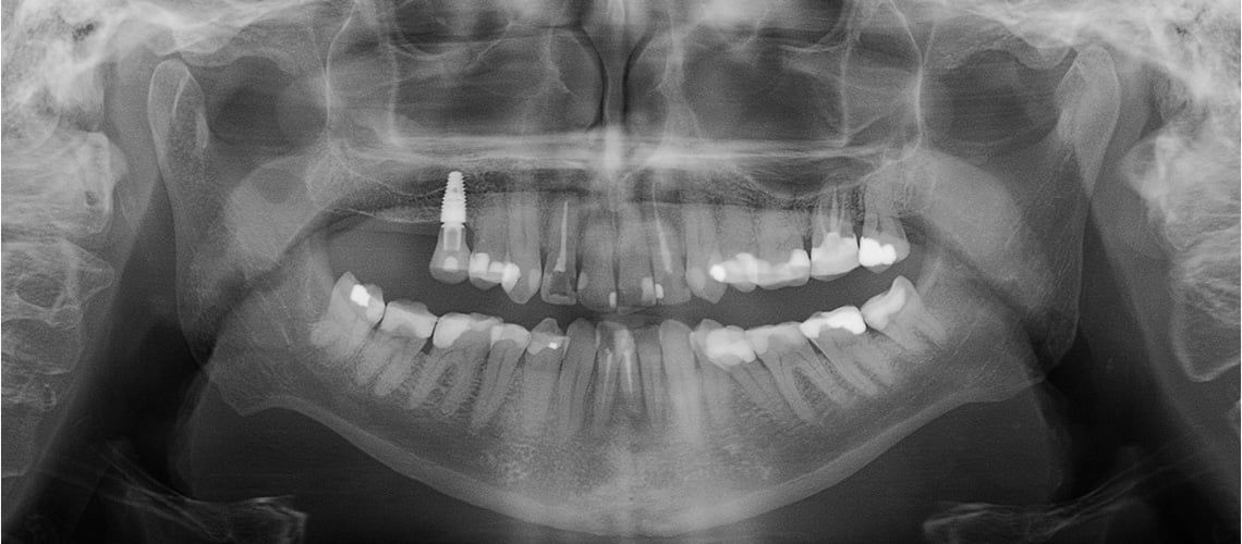 panoramic x-ray